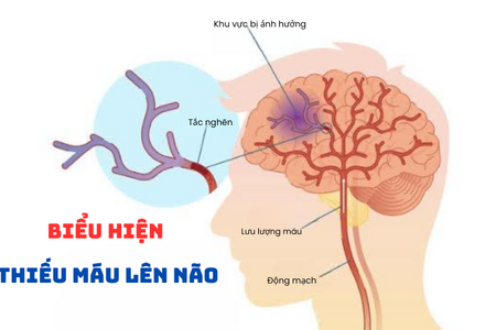 Biểu hiện của thiếu máu lên não: Đừng bỏ qua!