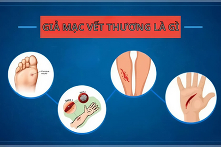 Giả mạc vết thương là gì: Tìm hiểu về lớp màng bảo vệ vết thương