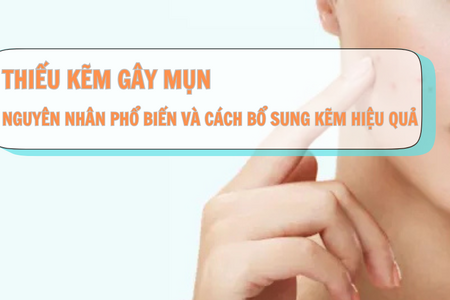 Thiếu kẽm gây mụn: Nguyên nhân phổ biến và cách bổ sung kẽm hiệu quả