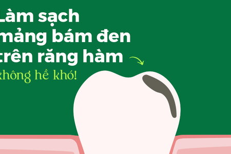 Làm sạch mảng bám đen trên răng hàm không hề khó!