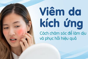 Viêm da kích ứng: Cách chăm sóc để làm dịu và phục hồi hiệu quả