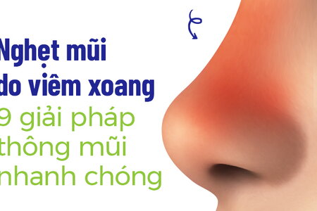 Nghẹt mũi do viêm xoang: 9 giải pháp thông mũi nhanh chóng