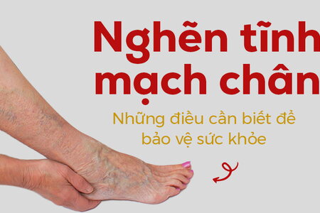 Nghẽn tĩnh mạch chân – Những điều cần biết để bảo vệ sức khỏe