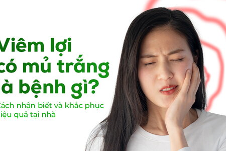 Viêm lợi có mủ trắng là bệnh gì? Cách nhận biết và khắc phục hiệu quả