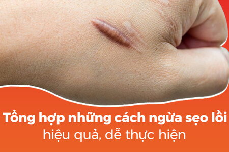 Tổng hợp những cách ngừa sẹo lồi hiệu quả, dễ thực hiện