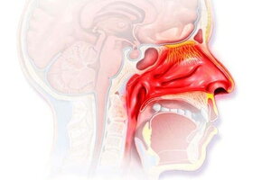 Viêm mũi phù nề: Nguyên nhân và các biện pháp điều trị