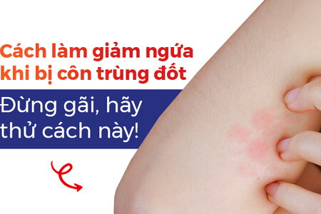 Cách làm giảm ngứa khi bị côn trùng đốt: Đừng gãi, hãy thử cách này!