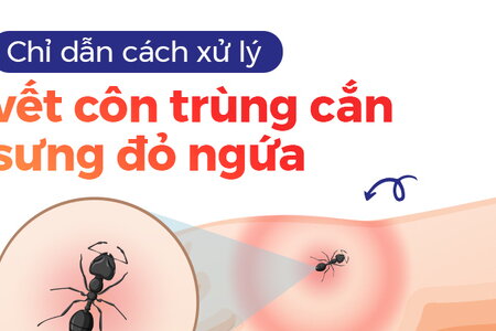 Chỉ dẫn cách xử lý vết côn trùng cắn sưng đỏ ngứa