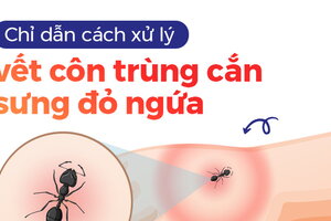 Chỉ dẫn cách xử lý vết côn trùng cắn sưng đỏ ngứa