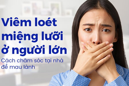 Viêm loét miệng lưỡi ở người lớn: Cách chăm sóc tại nhà để mau lành