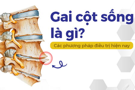 Gai cột sống là gì? Các phương pháp điều trị hiện nay