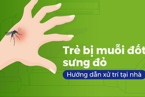 Trẻ bị muỗi đốt sưng đỏ: Hướng dẫn xử trí tại nhà