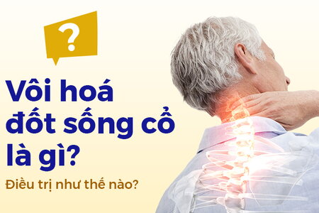 Vôi hóa đốt sống cổ là gì? Điều trị như thế nào?