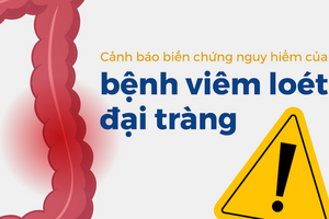 Cảnh báo biến chứng nguy hiểm của bệnh viêm loét đại tràng