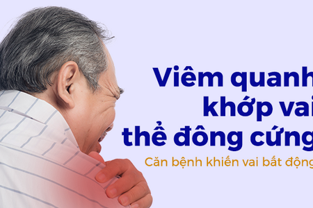 Viêm quanh khớp vai thể đông cứng – Căn bệnh khiến vai bất động
