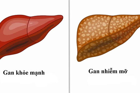 Gan nhiễm mỡ nhẹ: Dấu hiệu nhận biết và cách bảo vệ gan