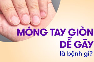 Móng tay giòn dễ gãy là bệnh gì, thiếu chất gì?