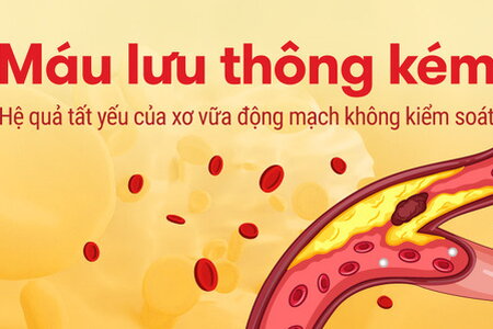 Máu lưu thông kém Hệ quả tất yếu của xơ vữa động mạch không kiểm soát