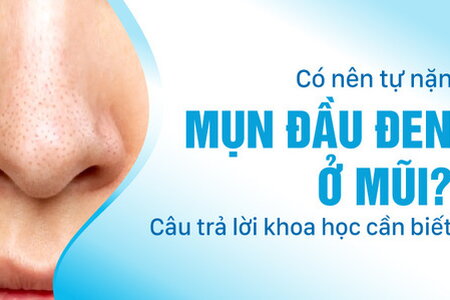 Có nên tự nặn mụn đầu đen ở mũi: Câu trả lời khoa học cần biết