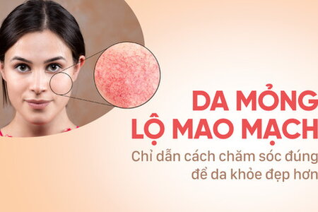 Da mỏng lộ mao mạch: Chỉ dẫn cách chăm sóc đúng để da khỏe đẹp hơn