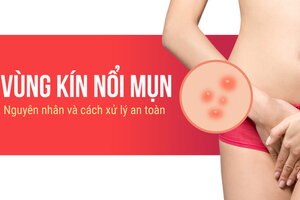 Vùng kín nổi mụn: Nguyên nhân và cách xử lý an toàn