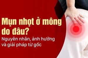 Mụn nhọt ở mông do đâu? Nguyên nhân, ảnh hưởng và giải pháp từ gốc