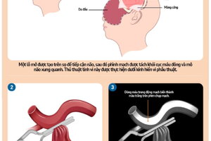 Vỡ phình động mạch não: Hành trình hồi phục gian nan