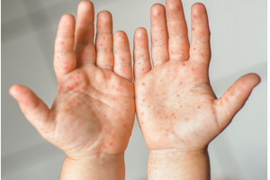 Sở Y tế TPHCM cảnh báo tác nhân EV71 xuất hiện trở lại