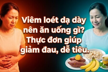 Viêm loét dạ dày nên ăn uống gì? Thực đơn giúp giảm đau, dễ tiêu
