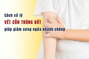 Cách xử lý vết côn trùng đốt giúp giảm sưng ngứa nhanh chóng
