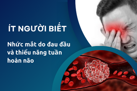 Ít người biết nhức mắt do đau đầu và thiểu năng tuần hoàn não