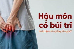 Hậu môn có búi trĩ là do bệnh trĩ nội hay trĩ ngoại?