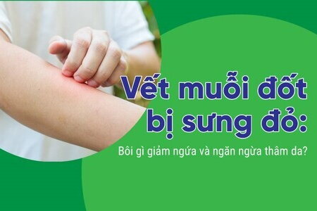 Vết muỗi đốt bị sưng đỏ: Bôi gì giảm ngứa và ngăn ngừa thâm da?