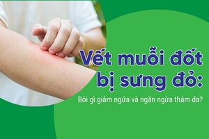 Vết muỗi đốt bị sưng đỏ: Bôi gì giảm ngứa và ngăn ngừa thâm da?