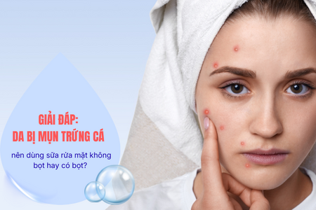 Giải đáp Da bị mụn trứng cá nên dùng sữa rửa mặt không bọt hay có bọt