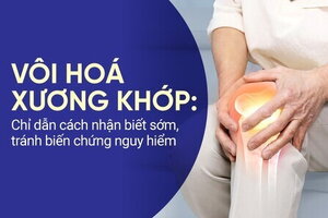 Vôi hoá xương khớp: Chỉ dẫn cách nhận biết sớm, tránh biến chứng