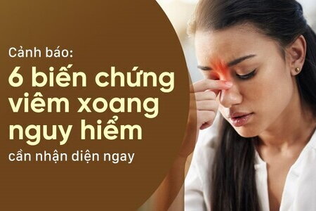 Cảnh báo: 6 biến chứng viêm xoang nguy hiểm cần nhận diện ngay
