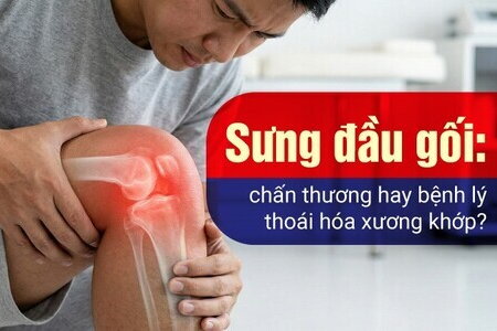 Sưng đầu gối: chấn thương hay bệnh lý thoái hóa xương khớp?