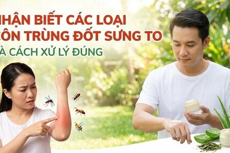 Nhận biết các loại côn trùng đốt sưng to và cách xử lý đúng