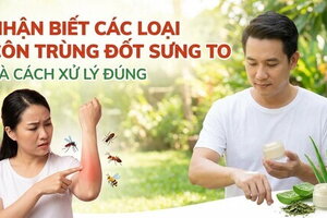 Nhận biết các loại côn trùng đốt sưng to và cách xử lý đúng