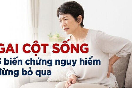 Gai cột sống: 5 biến chứng nguy hiểm đừng bỏ qua