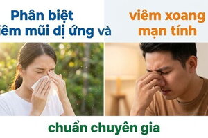 Phân biệt viêm mũi dị ứng và viêm xoang mạn tính chuẩn chuyên gia