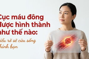 Cục máu đông được hình thành như thế nào: hiểu rõ sẽ cứu sống bạn