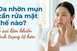 Da nhờn mụn cần rửa mặt thế nào? 5 sai lầm khiến tình trạng tệ hơn