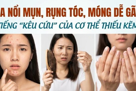 Da nổi mụn, rụng tóc, móng dễ gãy tiếng kêu cứu của cơ thể thiếu kẽm