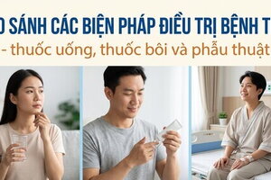So sánh biện pháp điều trị bệnh trĩ thuốc uống, thuốc bôi, phẫu thuật