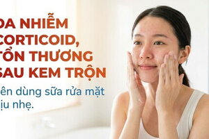 Da nhiễm corticoid, tổn thương sau kem trộn: dùng sữa rửa mặt dịu nhẹ