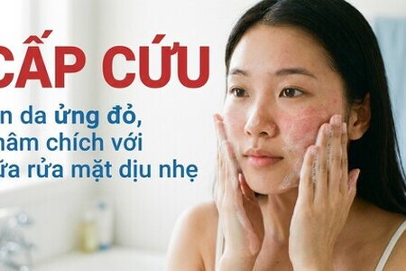 "Cấp cứu" làn da ửng đỏ, châm chích với sữa rửa mặt dịu nhẹ