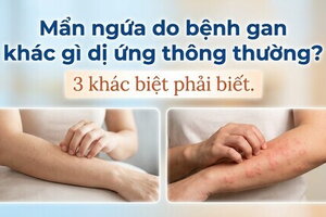 Mẩn ngứa do bệnh gan khác gì dị ứng thông thường? 3 khác biệt