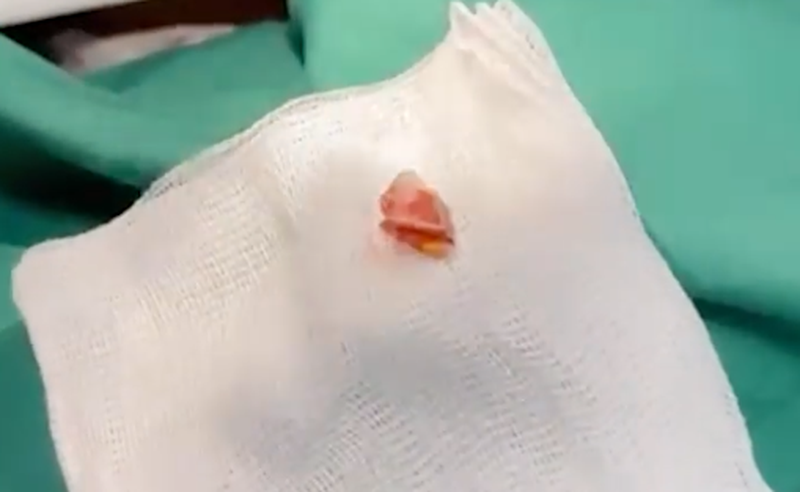 Nữ công nhân ho ra máu gần 2 năm vì vỏ kẹo rơi vào phế quản